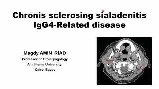 Chronic Sclerosing Sialadenitis IgG4 Related disease [upl. by Winson393]