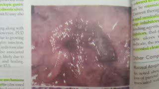 Peptic Ulcer Disease  SPECIAL PATHOLOGY [upl. by Nimajnab358]