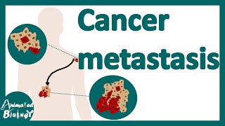 Cancer Metastasis  cancer metastasis mechanism  Metastasis  How do cancers spread in the body [upl. by Palm]