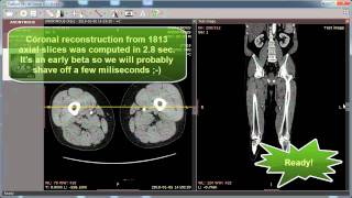 RadiAnt DICOM Viewer MPR preview [upl. by Markiv]