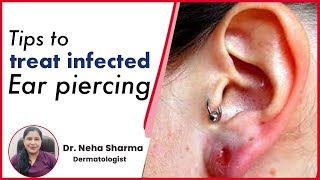 How to treat infected Ear Piercing  Timesxp [upl. by Colb]