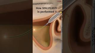 Balloon SINUPLASTY procedure sinusitistreatment sinuplasty shorts [upl. by Joappa]