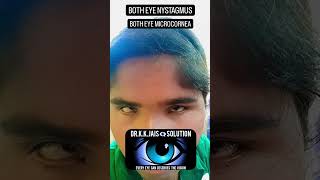 CONGENITAL NYSTAGMUS amp MICROCORNEA IN BOTH EYE ophthalmology eyes draakanshashomeopathy [upl. by Goldstein]