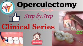 Operculectomy  Step by Step  Clinical Series [upl. by Ettegirb]