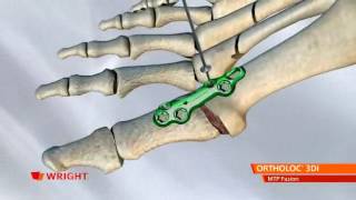 Wright  Ortholoc 3DI MTP Fusion NEW [upl. by Macdermot]