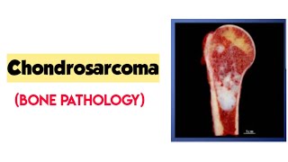 ChondrosarcomaBone pathologyRobbins pathologybone tumorforward focused [upl. by Carmina22]