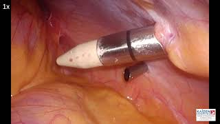 Robotic Splenic Cyst Excision [upl. by Kwok380]