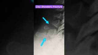 Spinal fracture  Clay Shovelers shorts radiology fracture [upl. by Scevo]