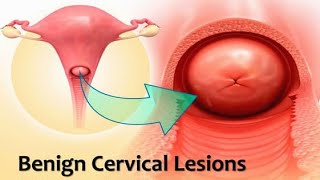 Benign Cervical Lesions Nabothian Follicles Polyps amp Cervical Stenosis Ten Teachers Gynecology [upl. by Boccaj]