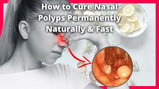 How to Cure Nasal Polyps Permanently Naturally and Fast Without Surgery 🙂 [upl. by Niknar732]