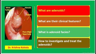 Adenoids Adenoid facies  Dr Krishna Koirala  Dr Krishnas ENT Lectures  Nepal ENT [upl. by Shaper539]