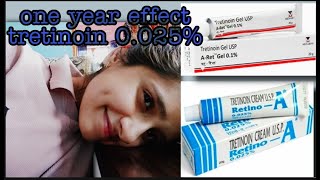 Tretinoin cream 0025 effects after one year [upl. by Ahsenrac448]