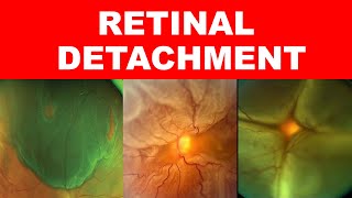 Retinal Detachment Types Risk Factors Pathophysiology Symptoms and Signs [upl. by Ennylhsa209]