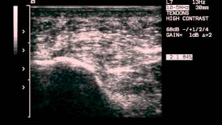 plantar fascia infiltrationwmv [upl. by Artus]