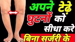 टेढ़े घुटनों को सीधा करे Knee Contractureघुटनों का गैप बढ़ाएBow Leg Treatment [upl. by Socem]