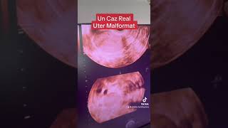 Un Caz Real Uter Malformat [upl. by Barthol596]