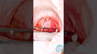 How Tonsil stones Develops tonsils tonsilstones science [upl. by Grekin]