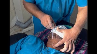 Needle cricothyroidotomy  DrSParthasarathy MD DNB PhD [upl. by Ahcsap]