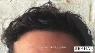 Dr Rahal Results  3133 FUE Grafts  Rahal Hair Transplant [upl. by Aiksa]