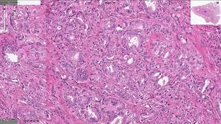 Prostatic Adenocarcinoma  Histopathology [upl. by Mchale572]