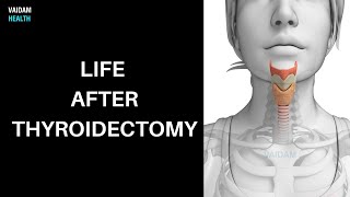 Life after Thyroidectomy [upl. by Niuqram]