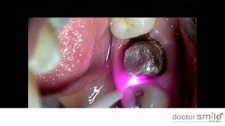 Doctor Smile Dental Laser diode gingival troughing [upl. by Atterual675]