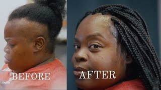 MY CLIENTS STORY Transform Your Life With Alopecia Box Braids [upl. by Caneghem399]