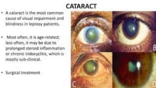 Effects of Leprosy on the Eyes [upl. by Lavicrep]