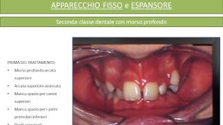 Apparecchio fisso e Espansore Prima e Dopo [upl. by Erskine]