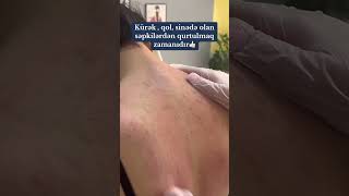 KÜRƏK AKNESİ  DERMATOLOQ [upl. by Meelas551]