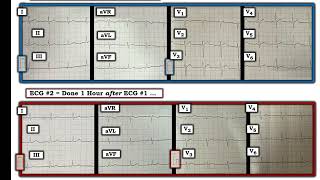 ECG Video Blog 407 — Why Did the Patient Die 12112023 [upl. by Lienet336]