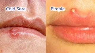 Pimple vs Cold Sore The Differences Identification and Treatment [upl. by Doniv]