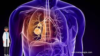 Die Rolle der Bestrahlung bei der Behandlung von Lungenkrebs [upl. by Maure]