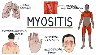 Understanding Myositis Polymyositis and Dermatomyositis [upl. by Marius644]