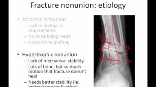 General principles of ortho trauma for PA students 5  Nonunion [upl. by Lien]