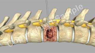 Back Surgery Kyphoplasty [upl. by Ybanrab]