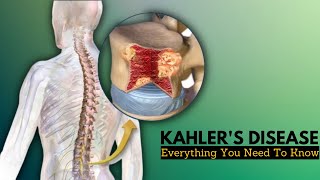 Kahlers Disease Causes Signs and Symptoms Diagnosis and Treatment [upl. by Ashbaugh]