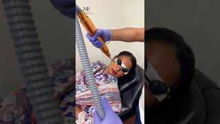 Pico Laser by Dr Rizwan Malik  MR Aesthetics Lahore  Dr Rizwan Malik  youtubeshorts trending [upl. by Bernie873]