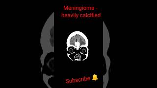 Meningioma heavily calcified shorts trending education [upl. by Salta]