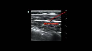 Ultrasound for peripheral nerve block of the lateral pectoral nerve [upl. by Anytsirhc423]