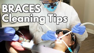 Cleaning Braces Tips amp Tricks for Dental Hygienists [upl. by Repooc47]