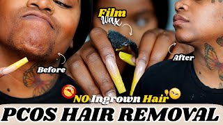 How to PCOS HAIR REMOVAL USING FILM WAX No ❌ Ingrown Hair ❌  Laurasia Andrea PCOS Hirsutism [upl. by Neile]