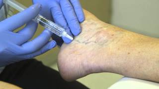 Spider Vein Treatment  Sclero Therapy [upl. by Nwahsauq]