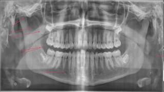 Interprétation de la panoramique dentaire [upl. by Gnolb589]