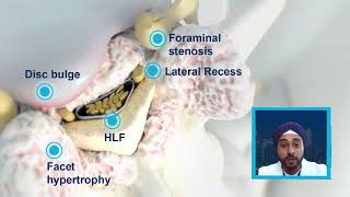 NYNJ Abstract  Mild Treatment Outcomes in the Presence of Foraminal Narrowing [upl. by Bradly]