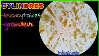 cylindres leucocytaires  cylindres granuleux cylindres cellulaires [upl. by Borlow53]