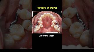 Crooked teeth braces process braces orthodontist dentist crookedteeth [upl. by Nirrak]