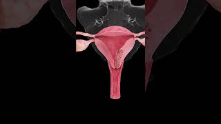 🎗️ Understanding Endometrial Cancer A Growing Concern for Women’s Health 🎗️ [upl. by Ocirema]