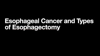 The Three Types of Esophagectomy [upl. by Josephina]