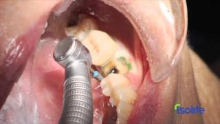 Isolite  The best isolation system for dental procedures [upl. by Trelu]